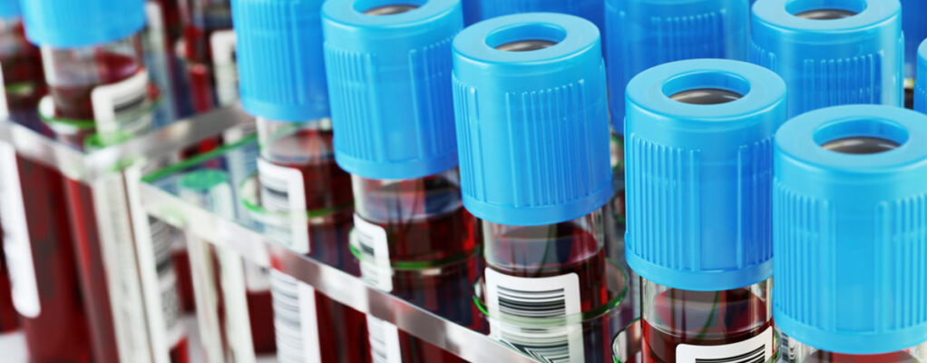 A rack with several rows of scientifically-labelled blood vials stand with blue lids, ready for testing.
