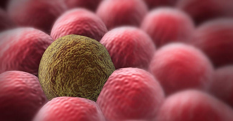 Sarcomatoid Mesothelioma, a Deadly Cancer of the Lungs