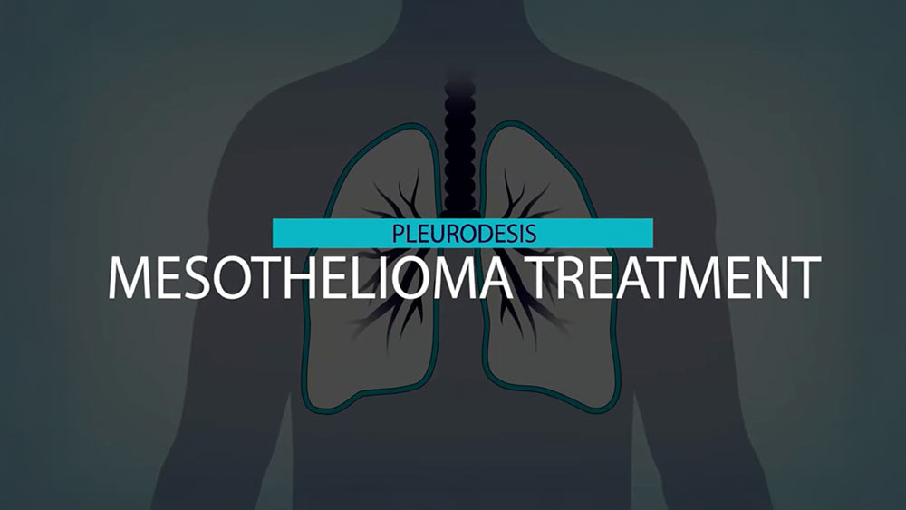 pleurodesis mesothelioma treatment